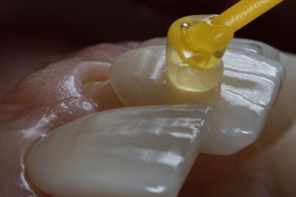 Carillas dentales materiales