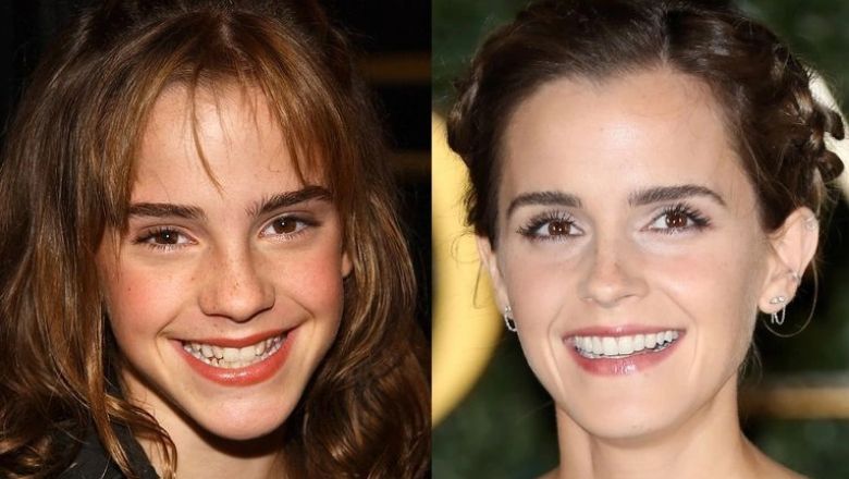 Emma Watson carillas dentales