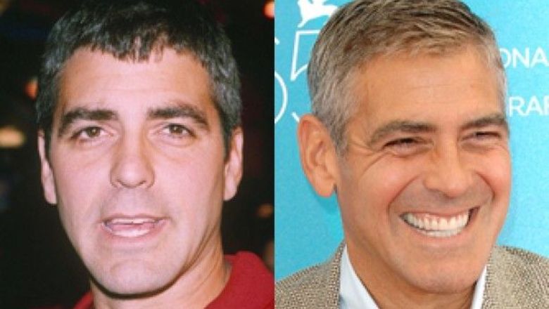 George Clooney carilla dental