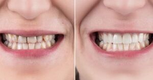 antes y despues de las carillas dentales
