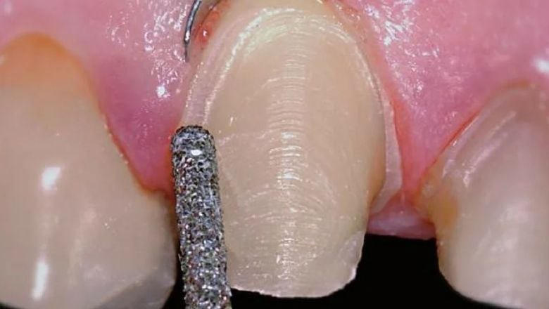 carillas dentales proceso