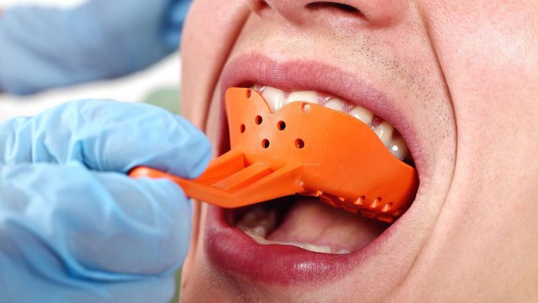 dientes antes de poner carillas dentales