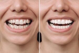 fotos de antes y despues de las carilla dentales
