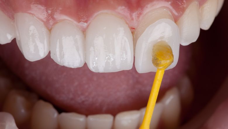 materiales de carillas dentales porcelana