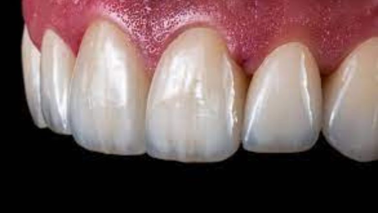 materiales de carillas dentales zirconio