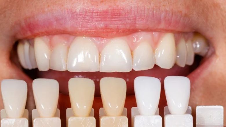materiales para carillas dentales