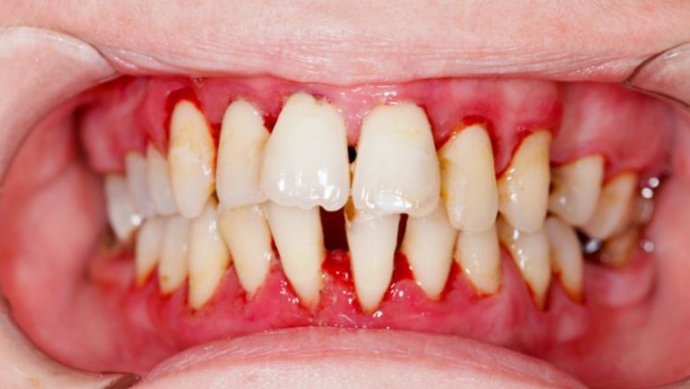 tratamiento de periodontitis