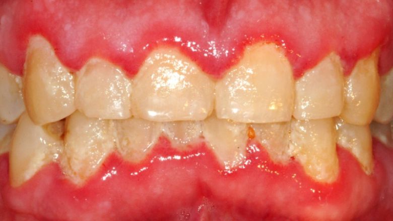 tratamiento periodontal