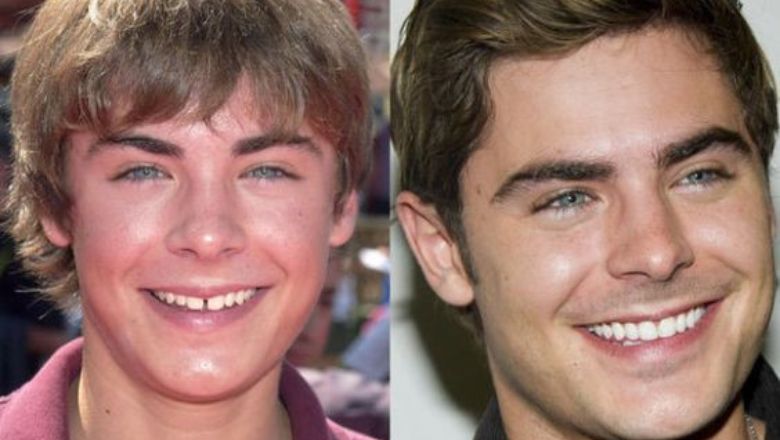zac efron carillas dentales