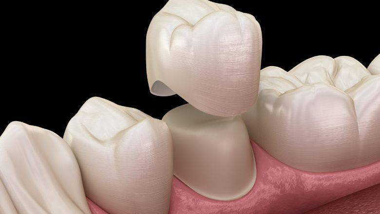 dientes fijos o removibles