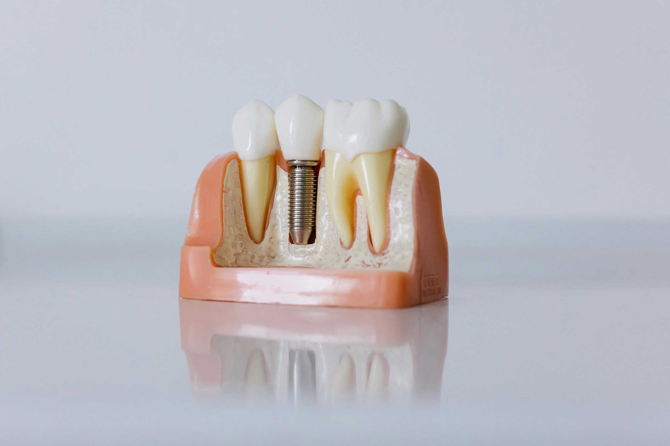 Implantes dentales