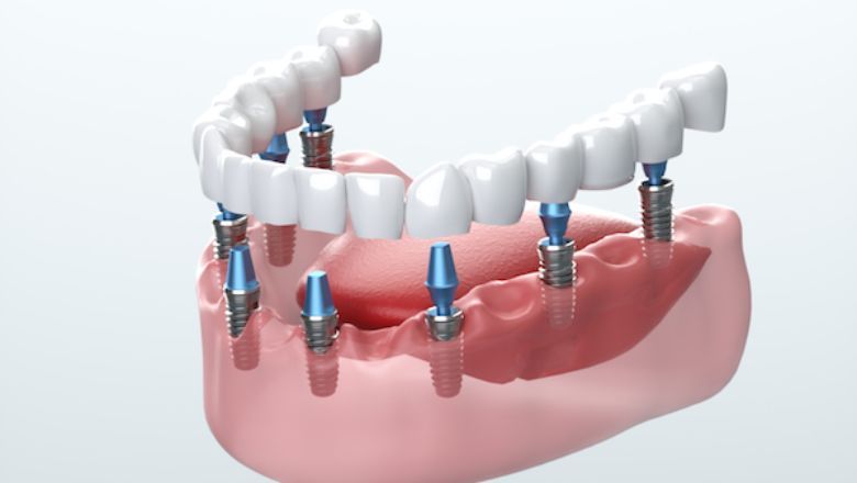 protesis fija o removible implantes dentales