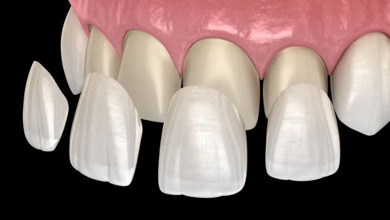 protesis removibles y fijas carillas dentales