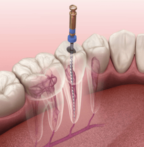 Endodoncia