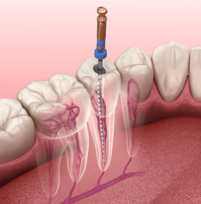 Endodoncia