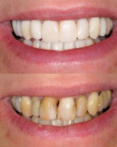 diseño de sonrisa dental