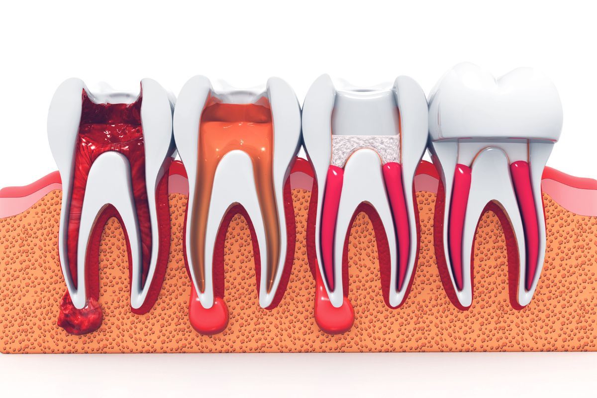 Tipos de endodoncia
