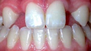 agenesia dental