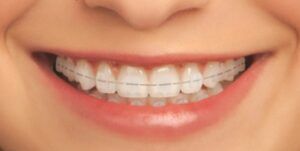 Brackets invisibles