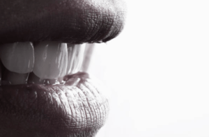 carillas dentales