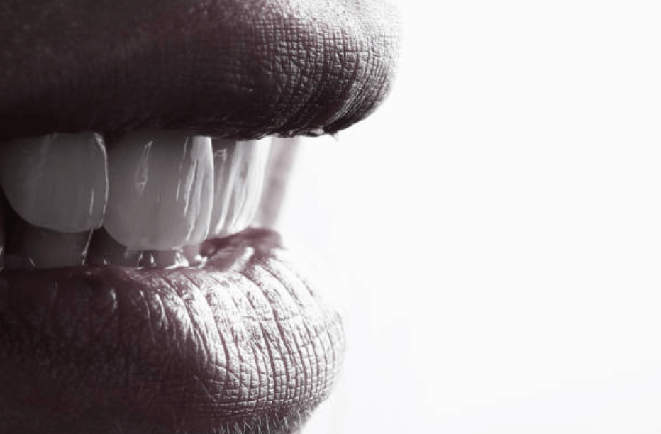 carillas dentales