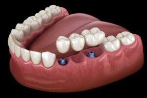 Pont fixe sobre implants