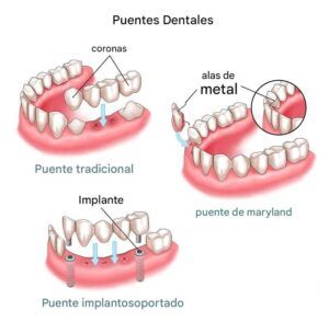 Puentes dentales fijos 