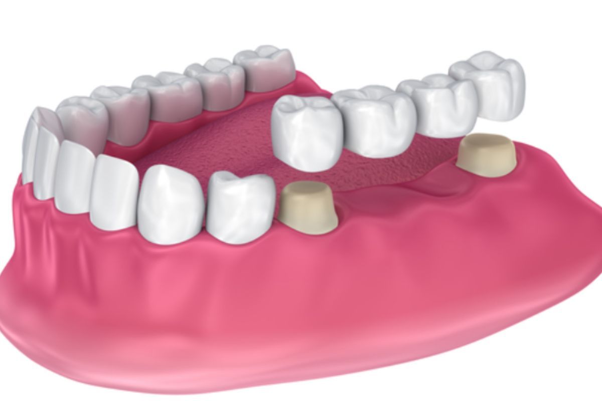 Puentes dentales fijos