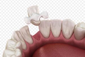 Pont dental tipus Maryland