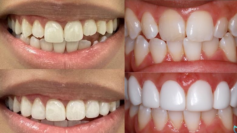 antes y despues de las carillas de composite