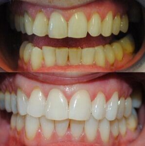 blanqueamiento dental antes y despues