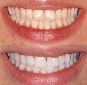 blanqueamiento dental antes y despues 4