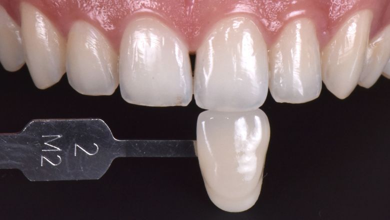 blanqueamiento dental rápido