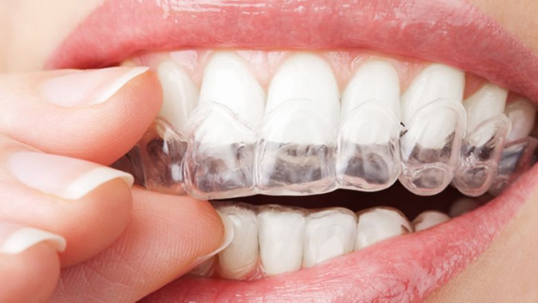 blanquear los dientes en casa