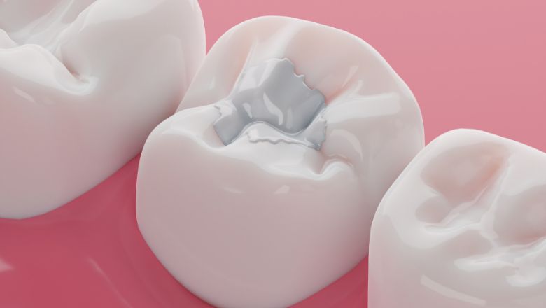 empastes dentales de composite