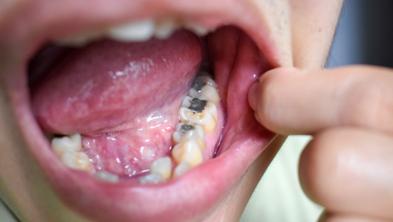 empastes dentales de plata