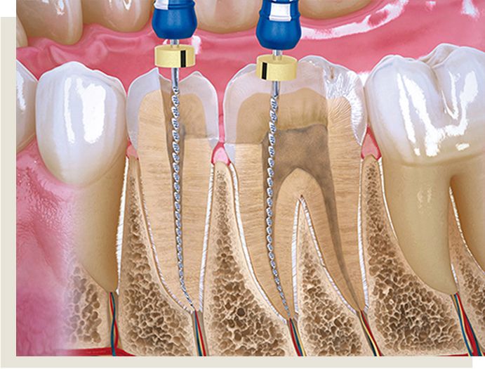 endodoncia