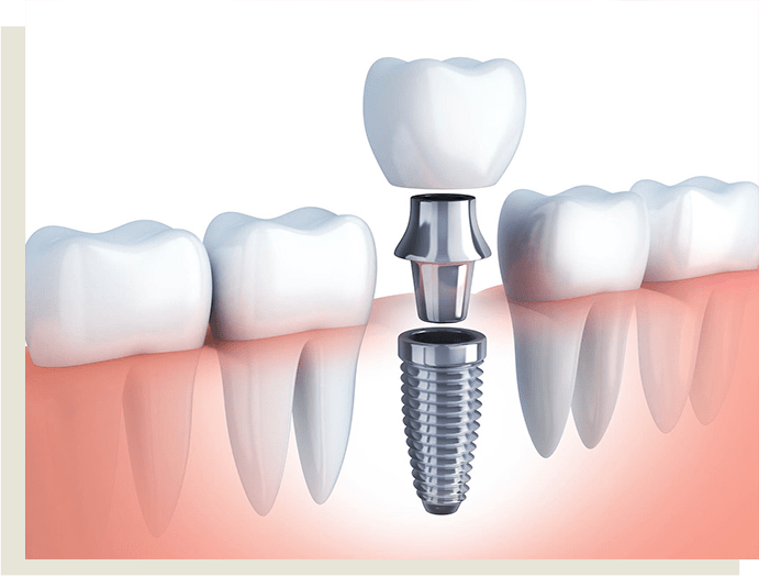 implantes dentales