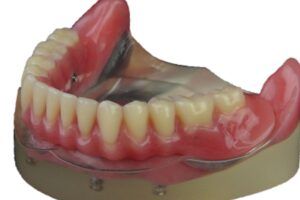 pròtesi dental peek