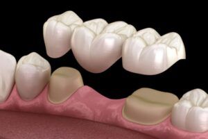 pont dental sobre dents