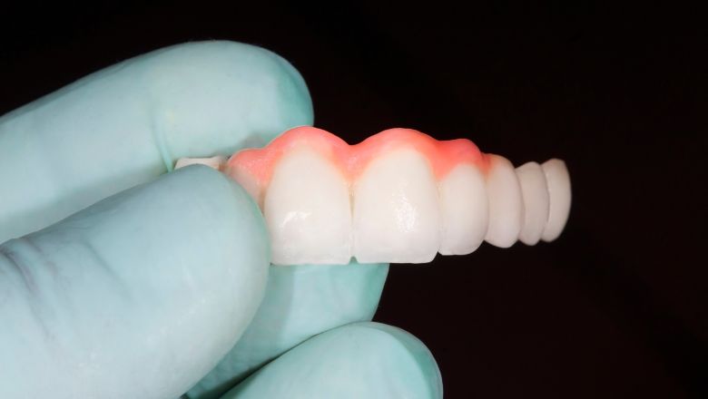 puentes dentales de 4 dientes