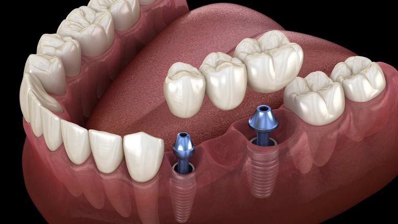puentes dentales precio
