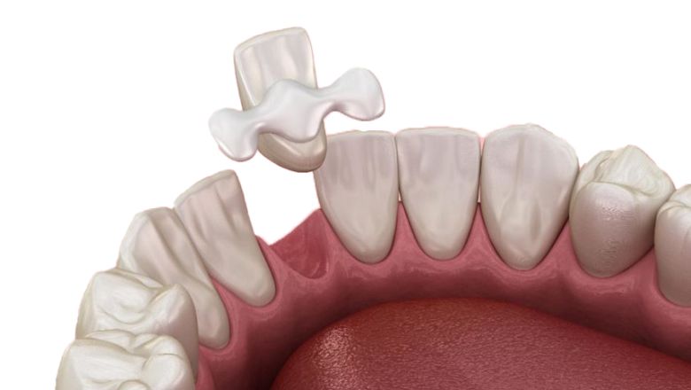 puentes dentales fijos