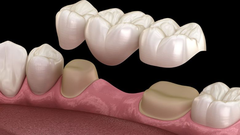 Puente dental precio
