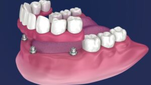 Sobredentadura con barra sobre 4 implantes