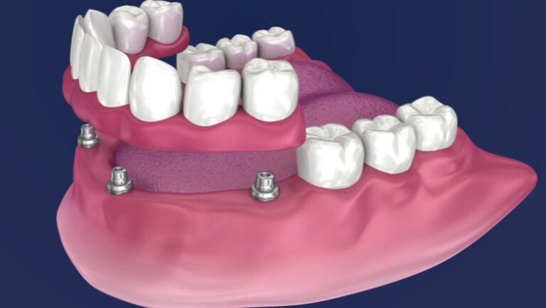 Sobredentadura sobre 4 implantes: todo sobre esta prótesis dental removible