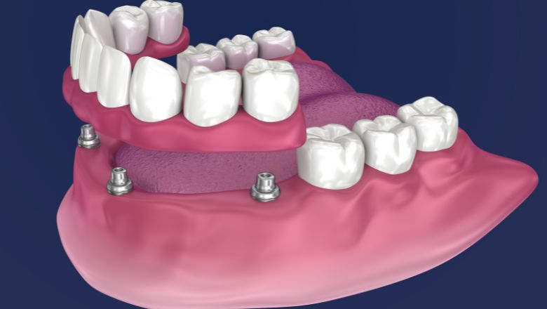 Sobredentadura con barra sobre 4 implantes