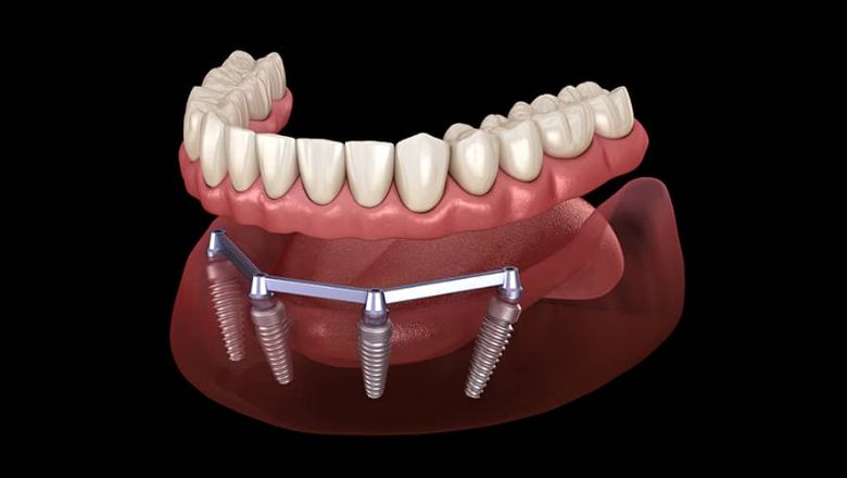 Sobredentadura amb barra sobre 4 implants