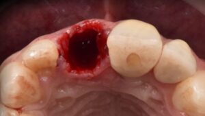 alveolitis dental seca