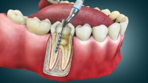 endodoncia multirradiculares
